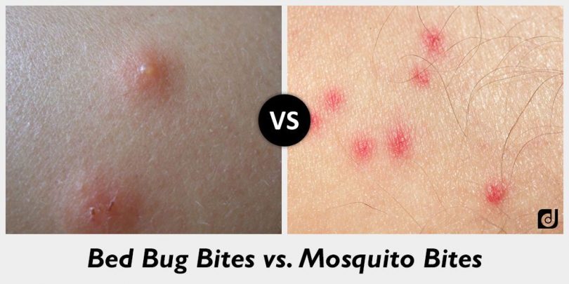 Bed Bug Bites Welts